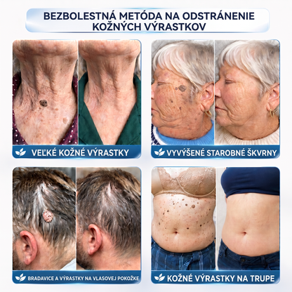 👩‍⚕️🎁Vitalisys® 𝟕-dňový krém na odstránenie kožných výrastkov a škvŕn (bezbolestná formula – bez jaziev) 🎀