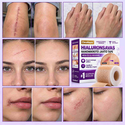 Vitalisys® Hyaluronsavas Nanomikrotű-hegjavító Tapasz