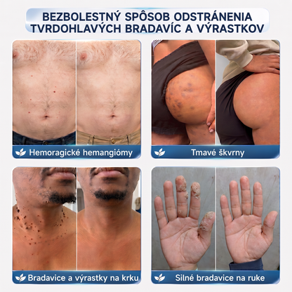 👩‍⚕️🎁Vitalisys® 𝟕-dňový krém na odstránenie kožných výrastkov a škvŕn (bezbolestná formula – bez jaziev) 🎀
