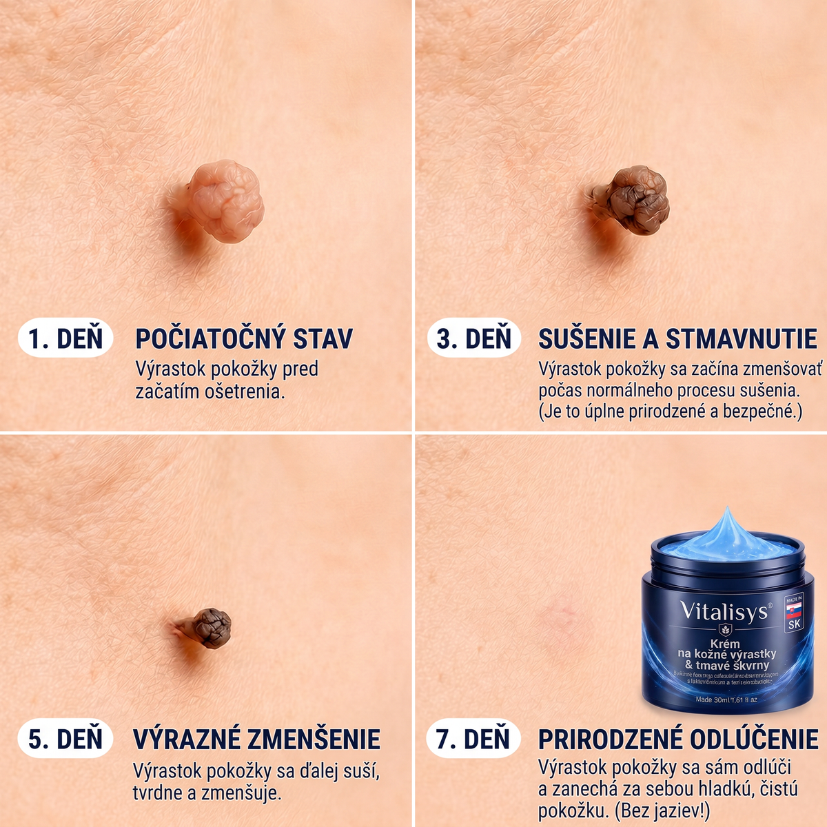 👩‍⚕️🎁Vitalisys® 𝟕-dňový krém na odstránenie kožných výrastkov a škvŕn (bezbolestná formula – bez jaziev) 🎀